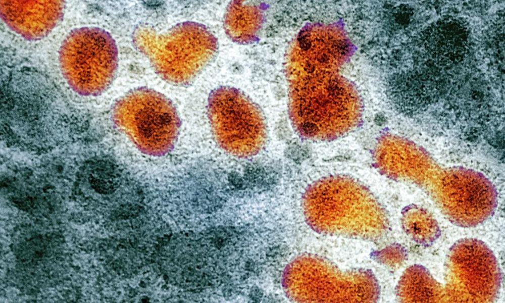 Primera muerte por la «súper gripe» A H3N2 en el país