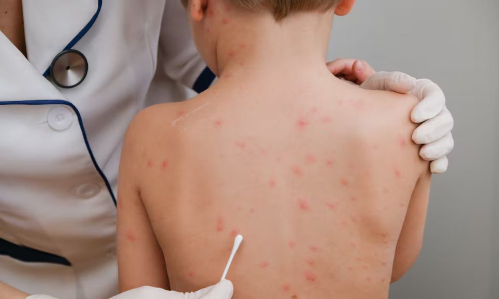 Alerta por brote de sarampión