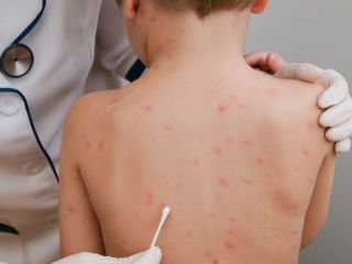 Sarampin en el AMBA: Crecen los casos y se ampla la circulacin viral