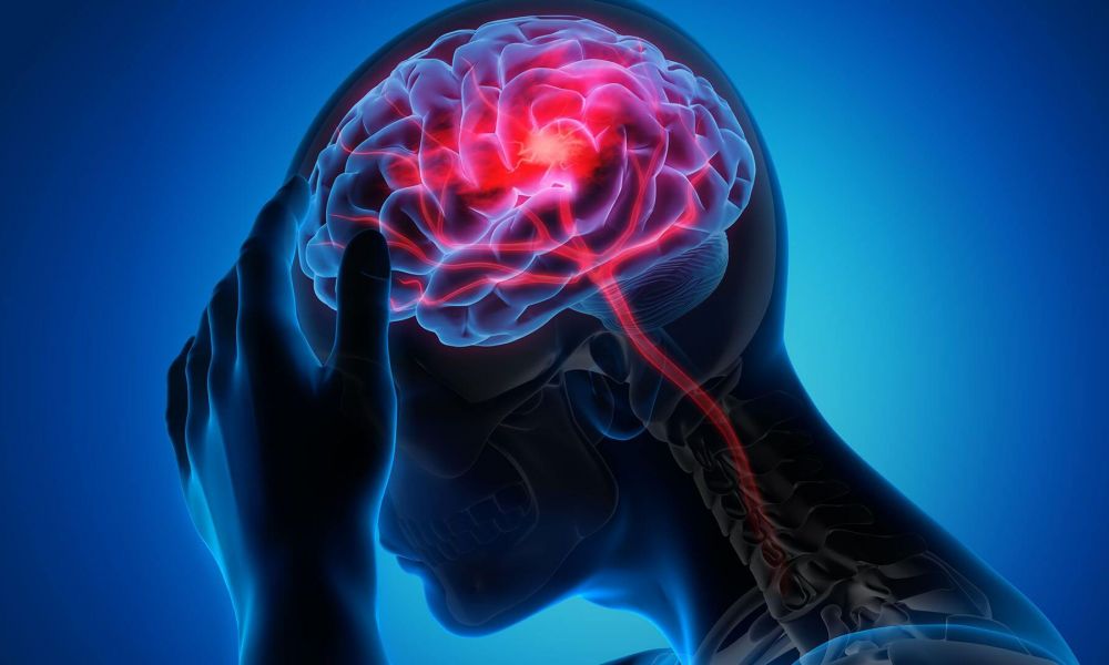 Alertan sobre el aumento de ACV en bonaerenses