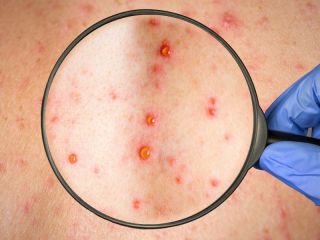 La provincia de Buenos Aires dio por cerrado el brote de sarampin tras ms de 20 semanas sin nuevos casos