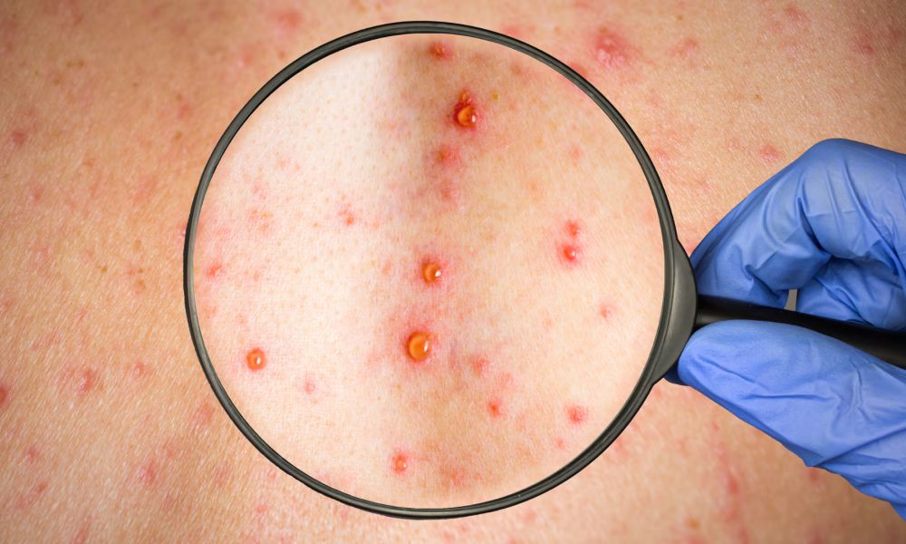 Buenos Aires dio por cerrado el brote de sarampión