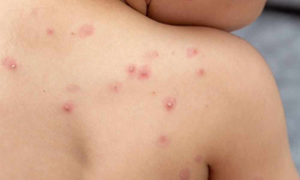 La Viruela del Mono en la Provincia