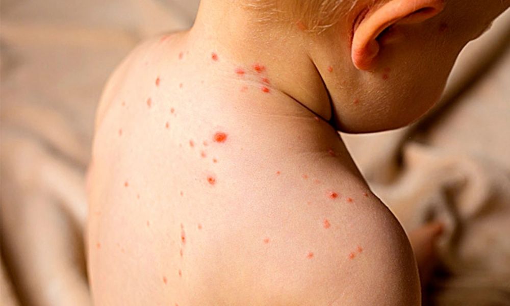 Alerta por sarampión
