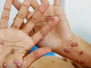 Alerta sanitaria en Argentina: Confirman el primer caso de Mpox de la variante más contagiosa