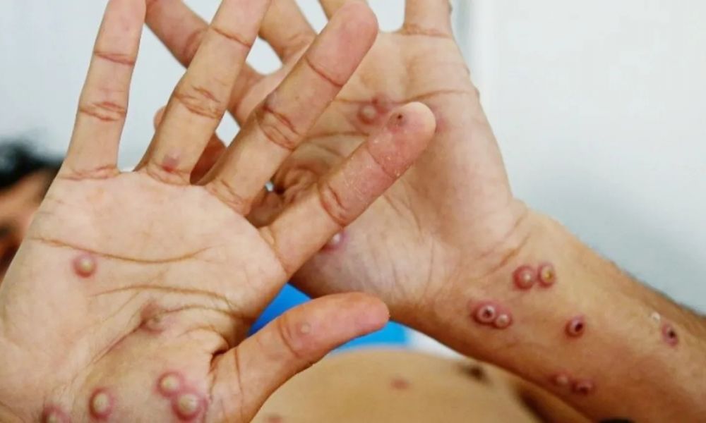 Confirman el primer caso de Mpox en Argentina