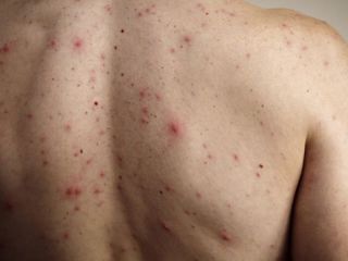 Confirman un caso de sarampi�n en CABA y refuerzan la vigilancia sanitaria