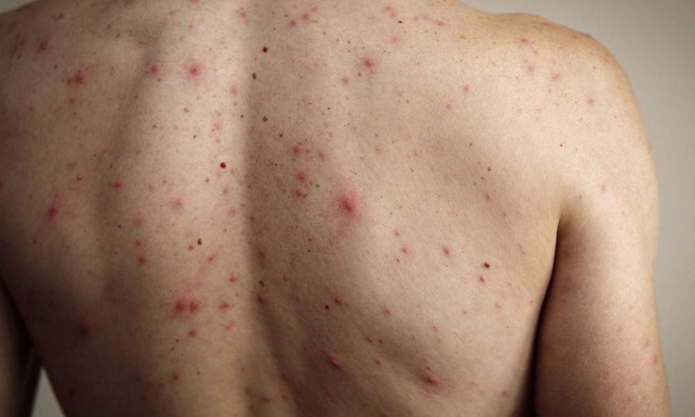 Confirman un caso de sarampión en CABA