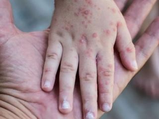 Alerta epidemiolgica: El sarampin avanza en la regin y preocupa la baja vacunacin