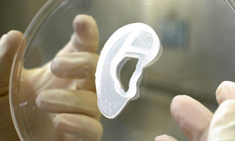 Trasplantan por primera vez una oreja impresa en 3D