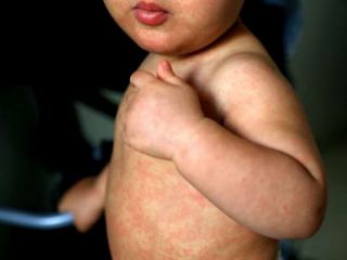 Crece el sarampin en el AMBA y alertan: Solo la vacuna corta la cadena de contagios