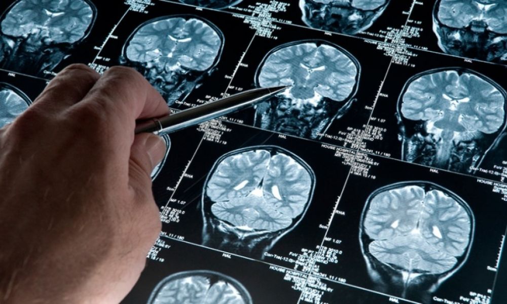 Software podría diagnosticar de forma precoz el Alzheimer
