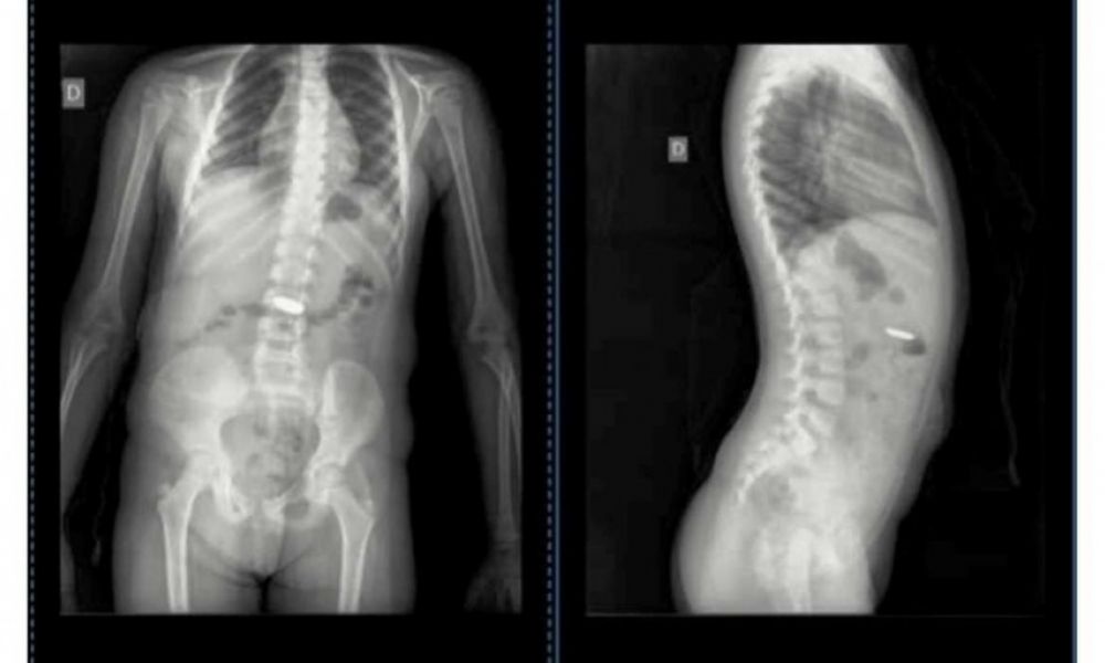 Durante 4 días con una pila en el estómago