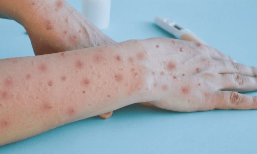 Confirmaron 265 casos de Viruela del mono en el país