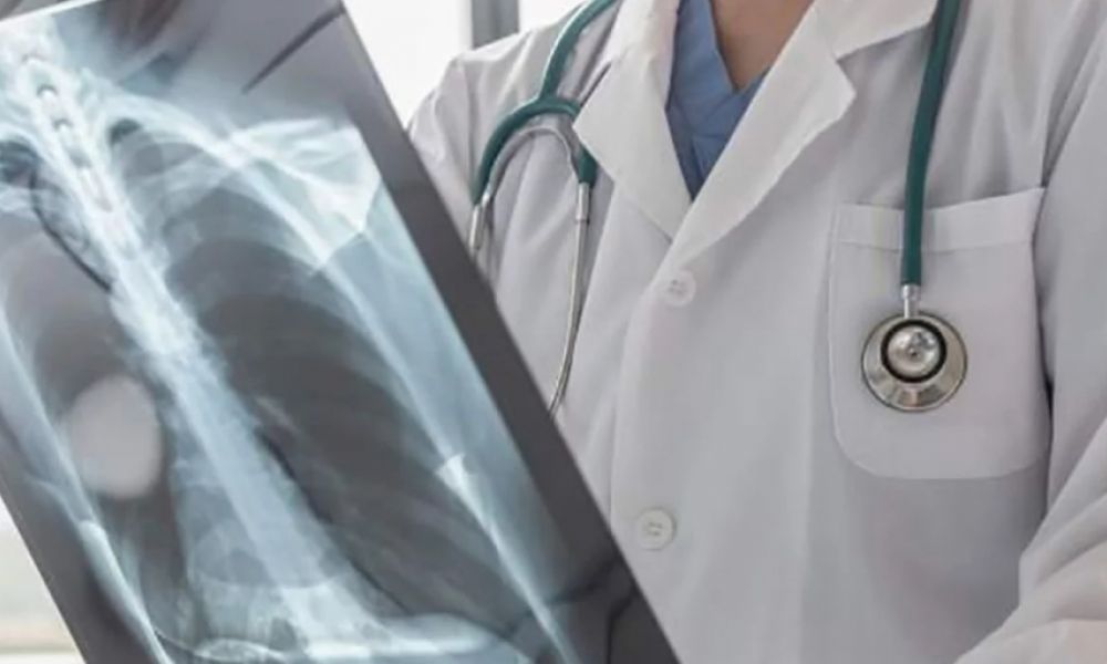 El cáncer de pulmón provoca una muerte por hora en Argentina